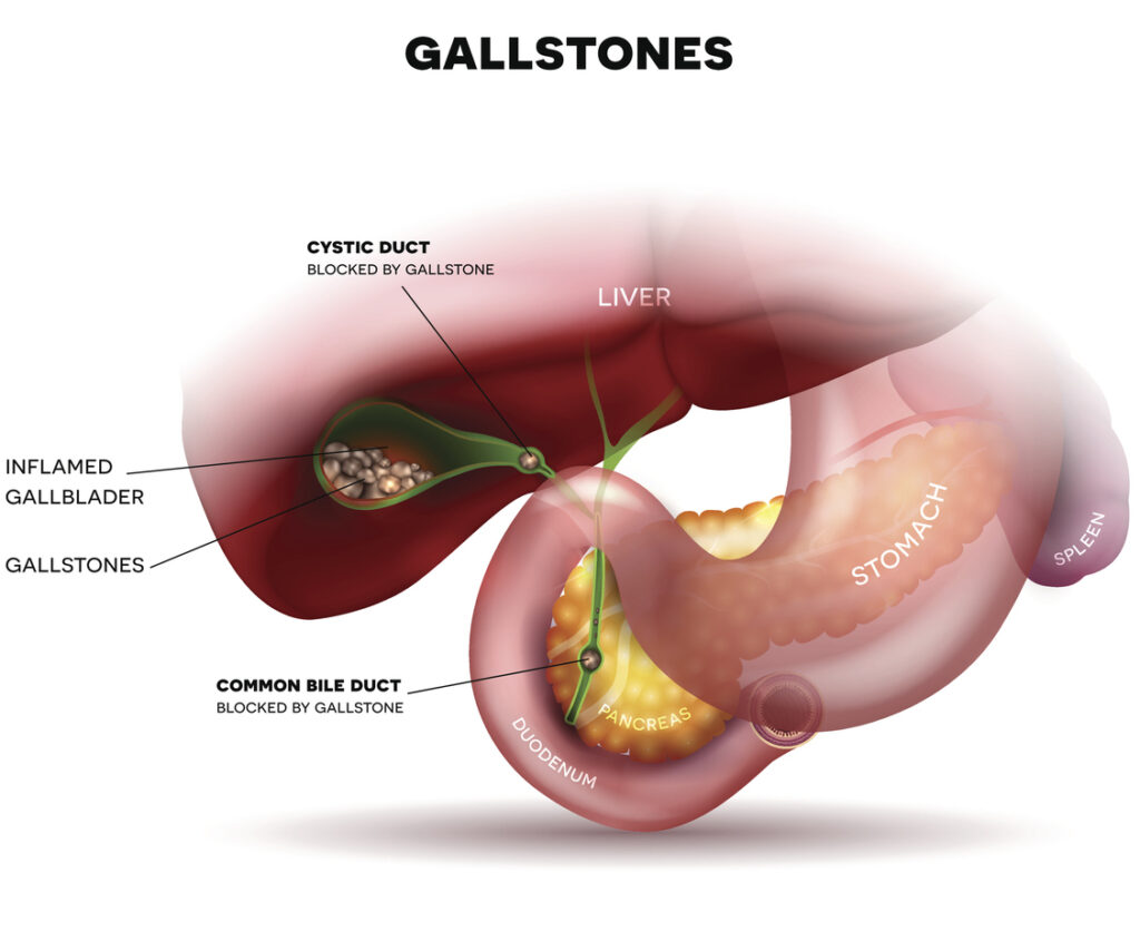 eliminate gallstones naturally with a liver cleanse