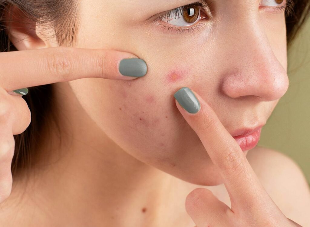 managing acne with diet