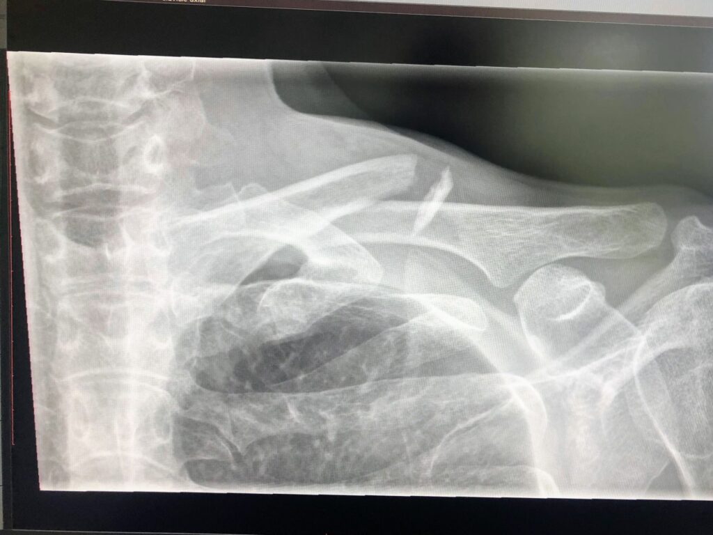 X Ray of the broken bone