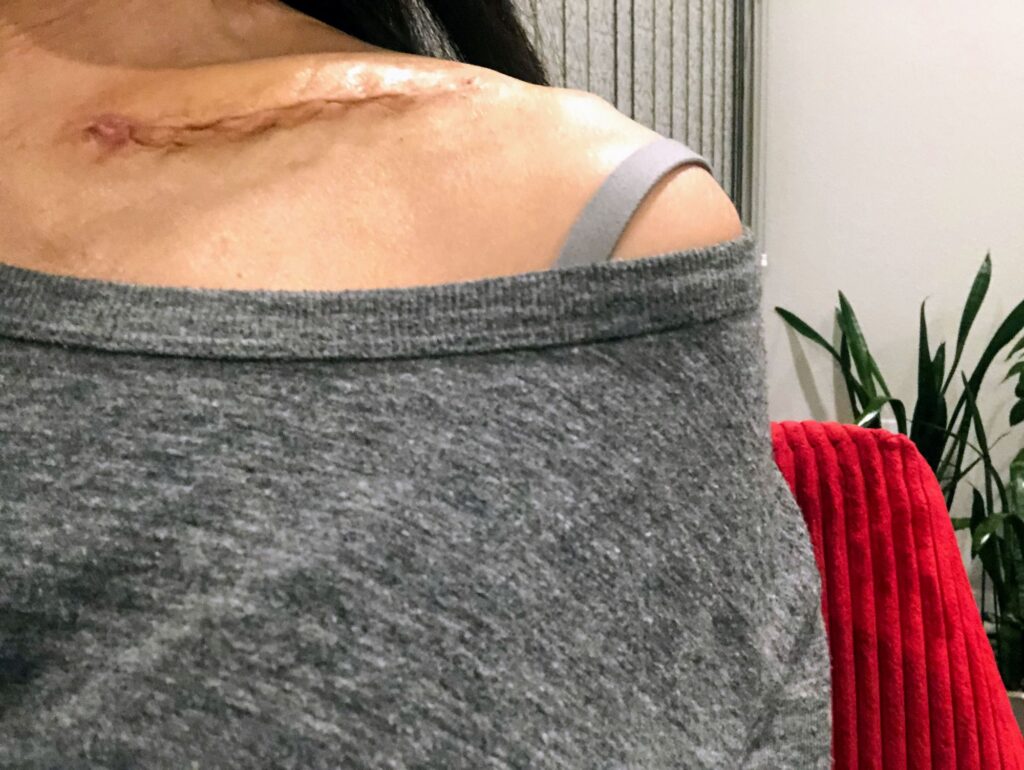 One month after my clavicle surgery
