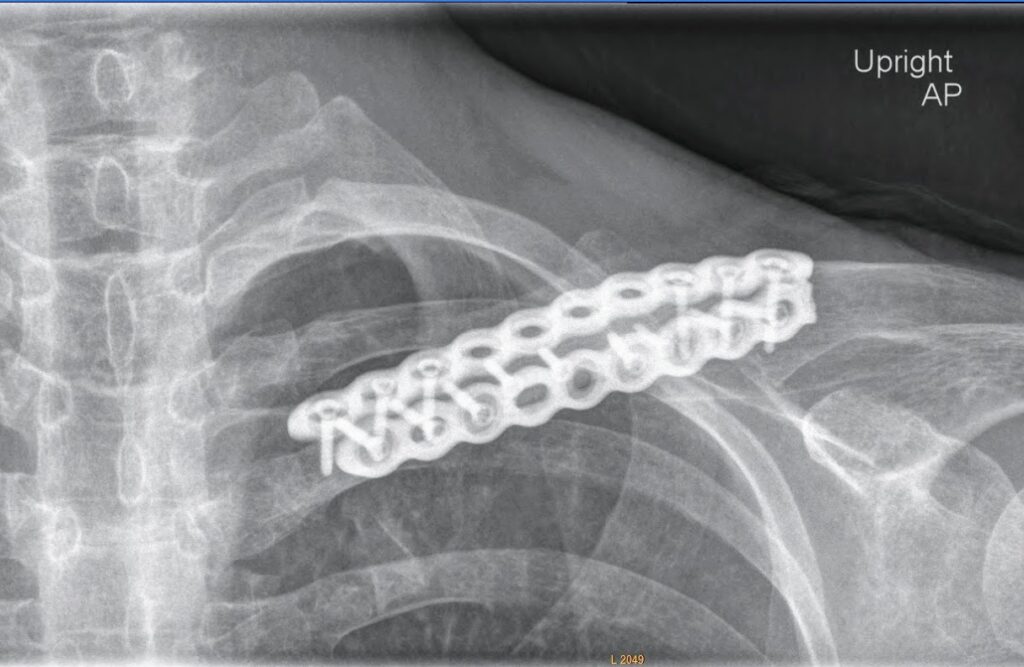 Titanium plate with 16 screws