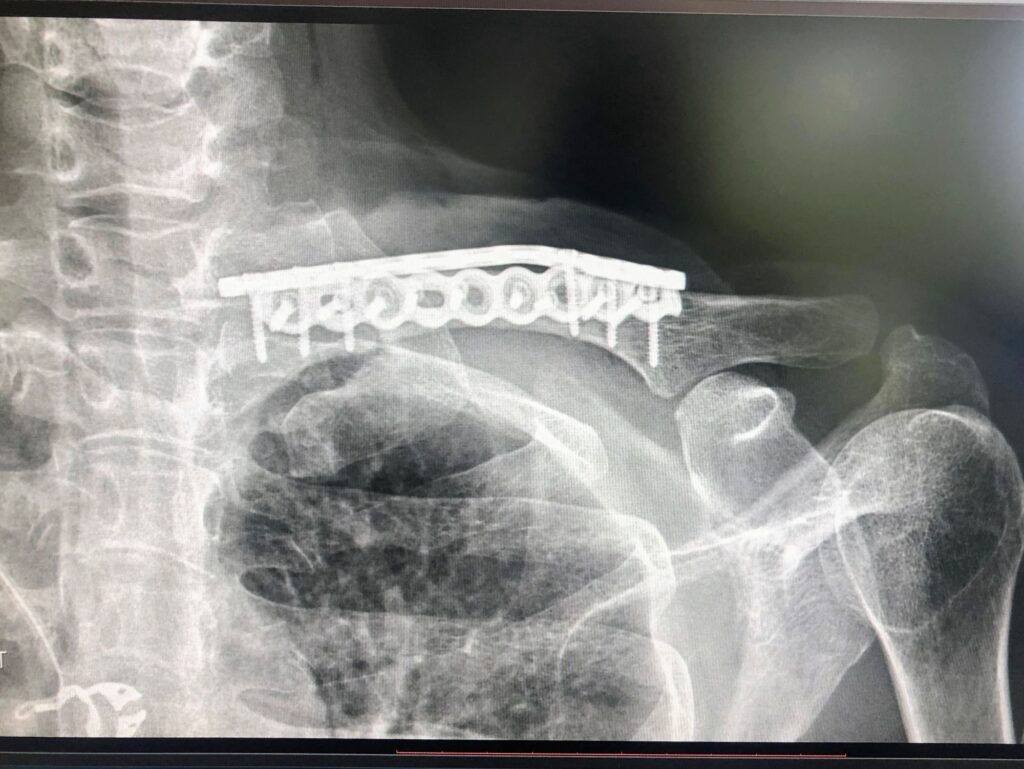 What to expect with Clavicle surgery